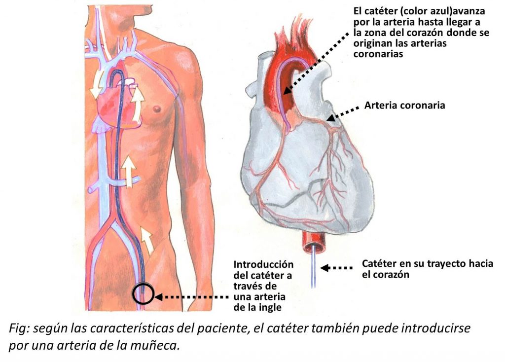 cateterismo cardiaco