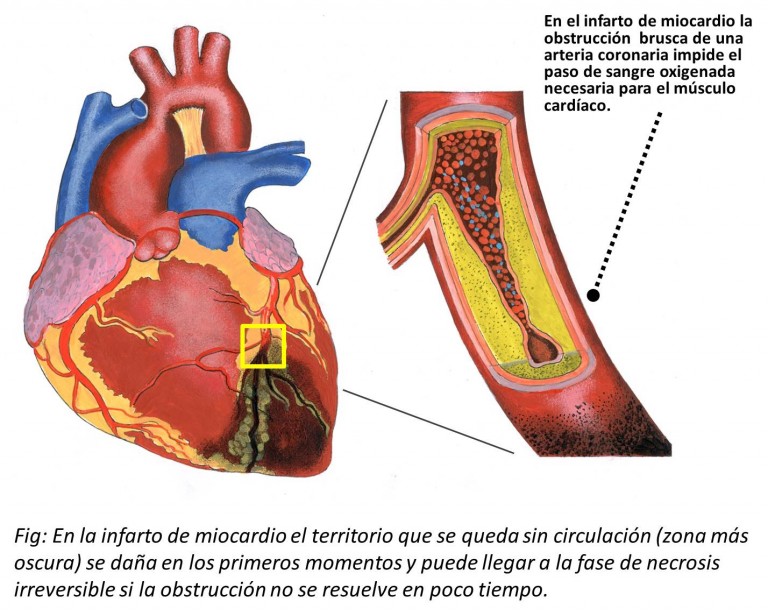 Infarto De Miocardio Cardiosaudeferrol